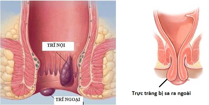 Cách phân biệt sa trực tràng và trĩ có thể bạn chưa biết!