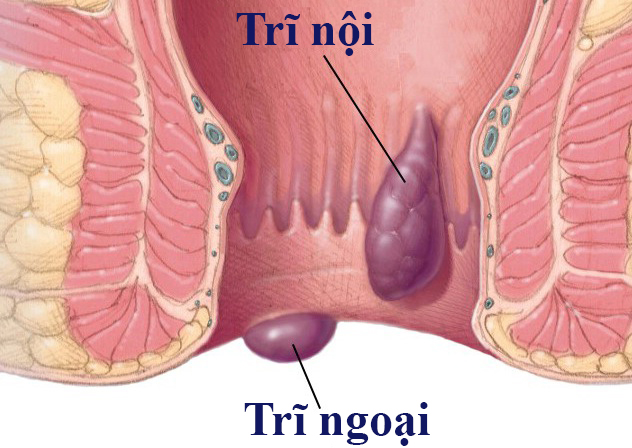 Bệnh trĩ ngoại và những thông tin quan trọng cần phải biết