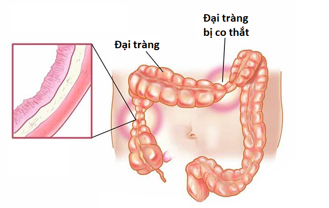 Ổn định nhu động ruột là nhiệm vụ không thể bỏ qua