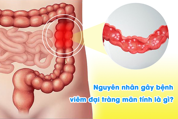 Nguyên nhân gây bệnh viêm đại tràng mãn tính là gì?