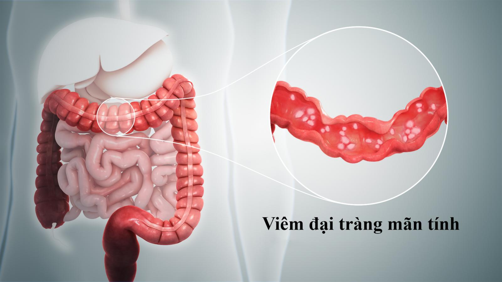 Viêm đại tràng mãn tính là nguyên nhân hàng đầu gây ra chướng bụng đầy hơi