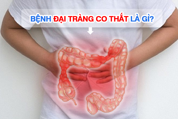 Bệnh đại tràng co thắt là gì?