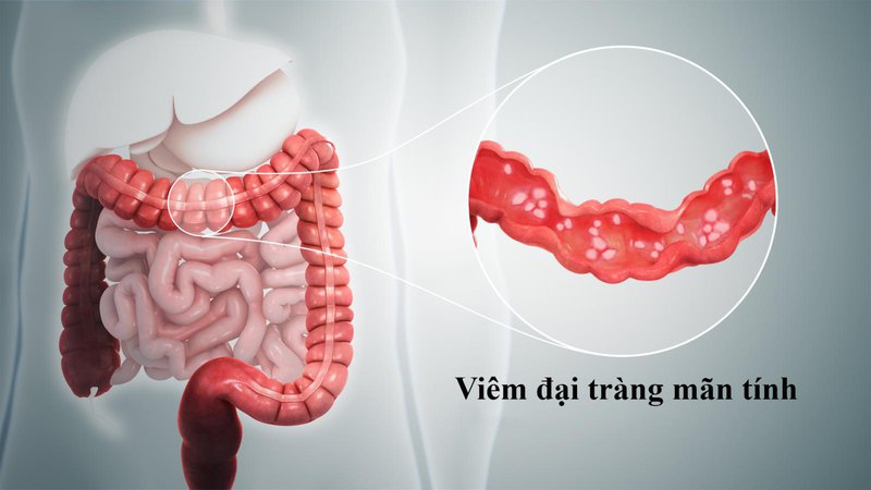 Viêm đại tràng mãn tính có những tổn thương nhất định trên niêm mạc