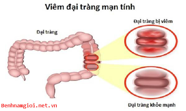 Viêm đại tràng mãn tính