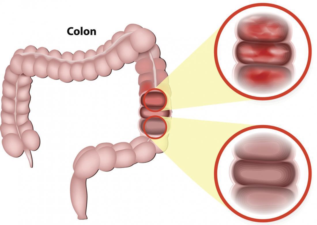 Cách phát hiện viêm đại tràng sớm và phương pháp khắc phục hiệu quả