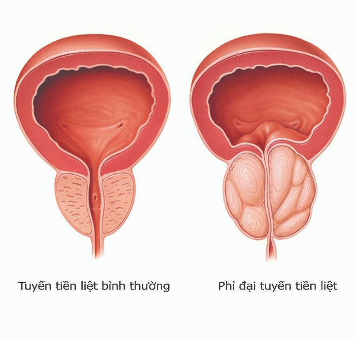 phì đại tiền liệt tuyến là gì