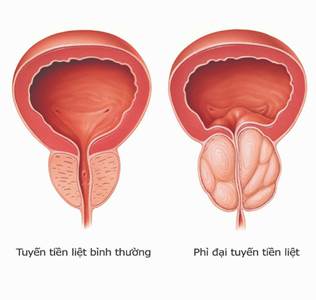 Hình ảnh: phì đại tuyến tiền liệt tuyến