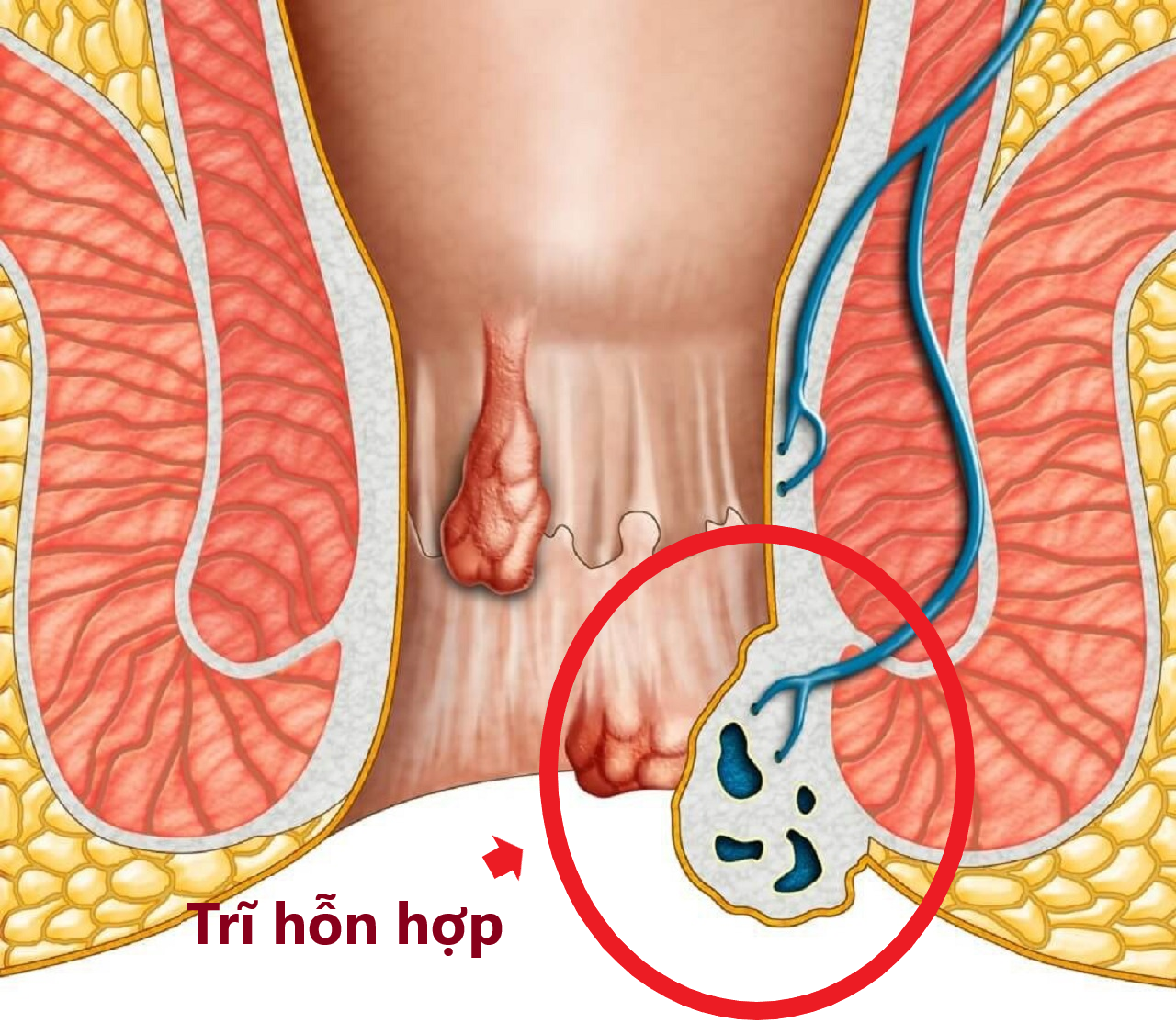 Bệnh trĩ hỗn hợp: Dấu hiệu, nguyên nhân, cách điều trị và phòng ngừa