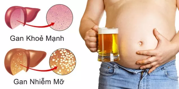 Bệnh gan nhiễm mỡ do rượu