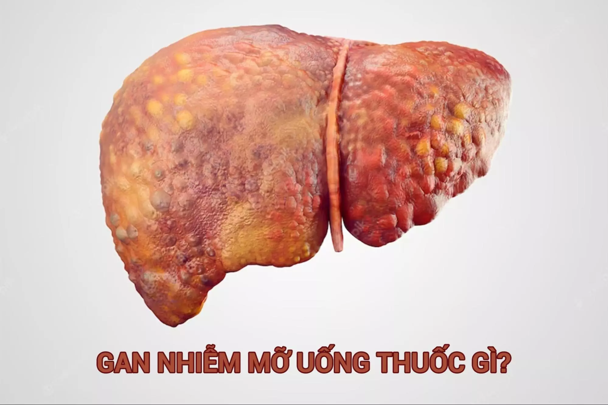 Bị gan nhiễm mỡ uống thuốc gì hiệu quả?