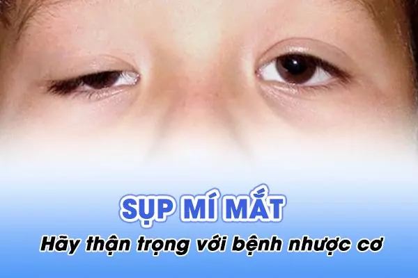 Sụp mí mắt - Hãy thận trọng với bệnh nhược cơ