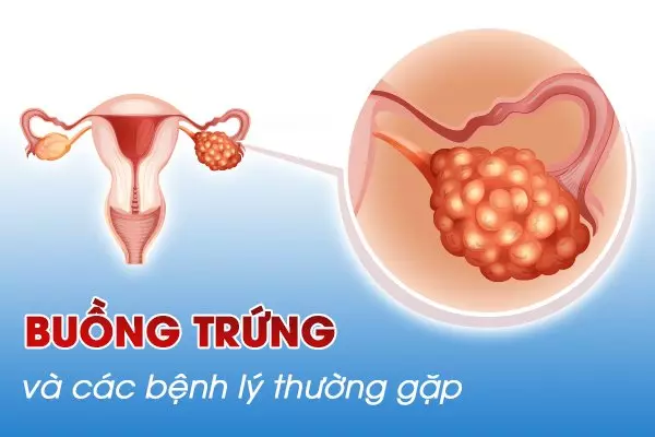 Tìm hiểu về buồng trứng và các bệnh lý thường gặp