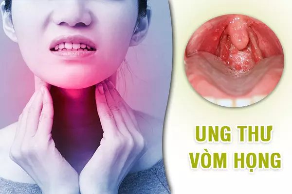 5 dấu hiệu giúp bạn nhận biết ung thư vòm họng không thể bỏ qua