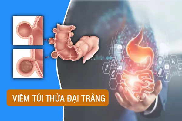 Bệnh viêm túi thừa đại tràng là gì? Có nguy hiểm không?