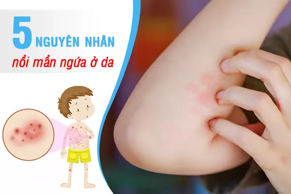 5 nguyên nhân khiến da bị nổi mẩn ngứa thường gặp nhất và cách khắc phục