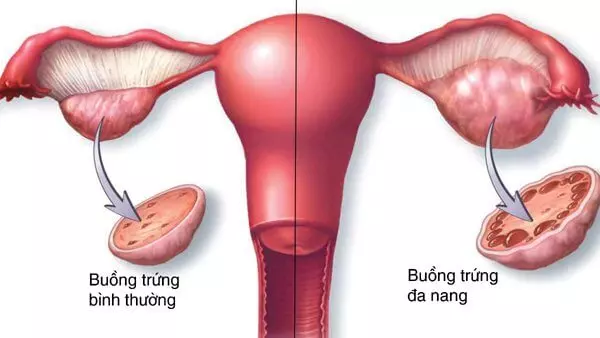 Nguyên nhân chính gây PCOS là rối loạn nội tiết tố