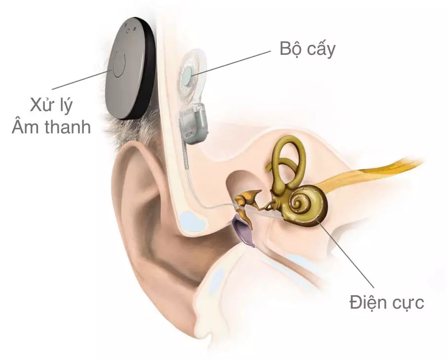 Chụp MRI