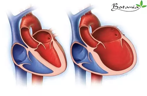 bệnh cơ tim giãn nở