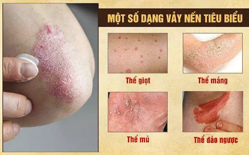 Một số thể vảy nến tiêu biểu