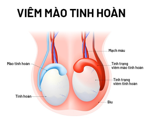 Viêm mào tinh hoàn - Một bệnh lý có thể gây vô sinh ở nam giới!