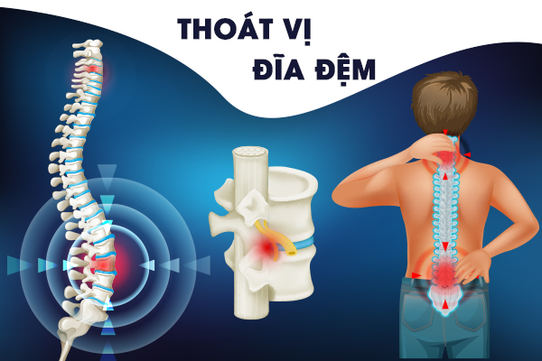 Thoát vị đĩa đệm là gì? Nguyên nhân, cách điều trị và phòng ngừa