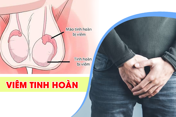 Viêm tinh hoàn - Nguyên nhân, triệu chứng, cách điều trị và phòng ngừa