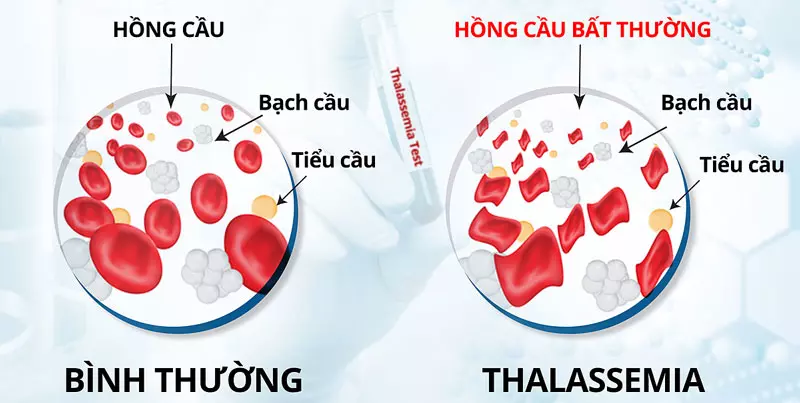 Tan máu bẩm sinh: Bạn biết gì về căn bệnh này?