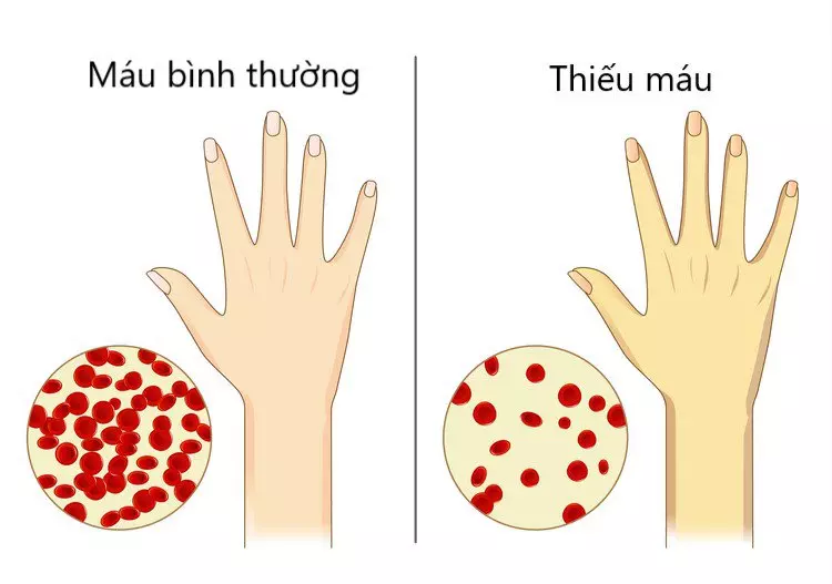 Thiếu máu mãn tính