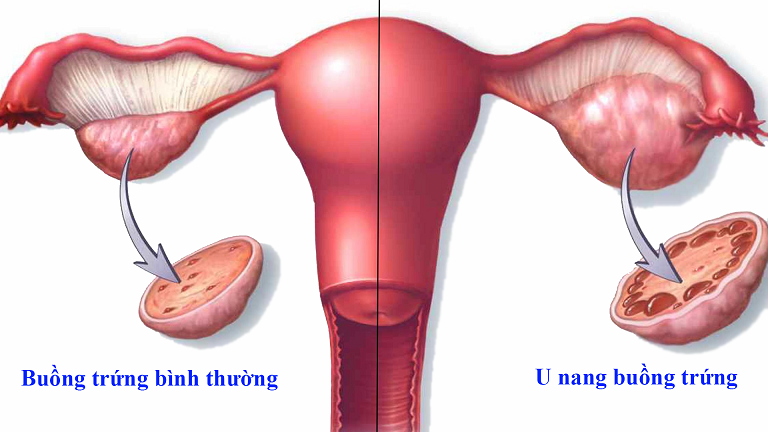 U nang buồng trứng có nguy hiểm không?