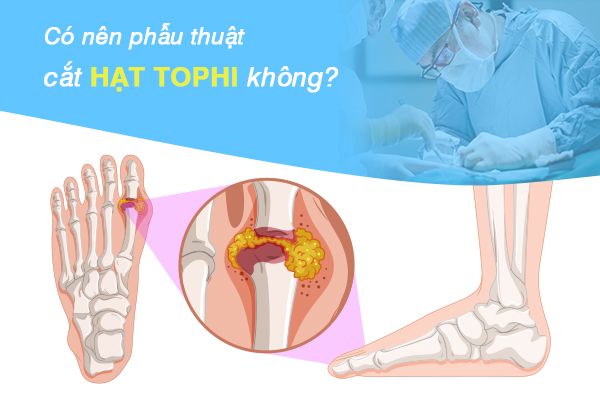 Tất tần tật những điều cần biết về phẫu thuật cắt hạt tophi