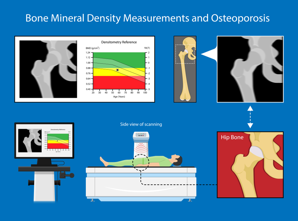 Người bệnh sẽ được đo mật độ xương trước khi dùng thuốc