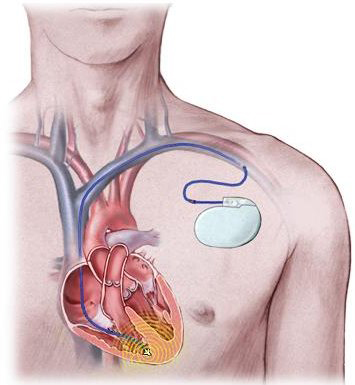 Máy phá rung tự động cấy vào cơ thể (ICD)