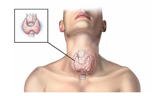 Tuyến giáp phát triển lớn khiến cổ phình to ra