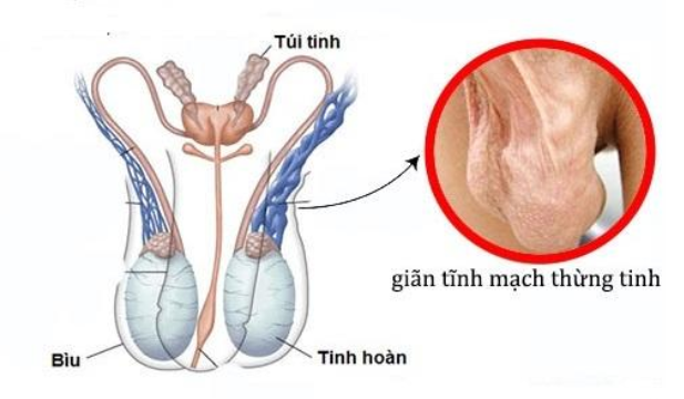 Aescin trong hạt dẻ ngựa có tác dụng hỗ trợ cải thiện bệnh suy giãn tĩnh mạch thừng tinh