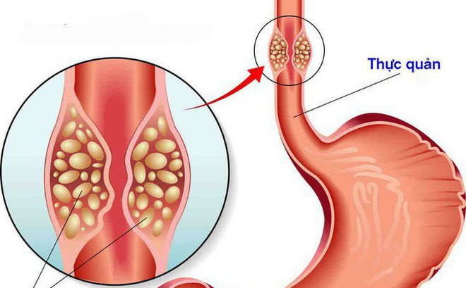 Trào ngược dạ dày thực quản có thể dẫn đến ung thư