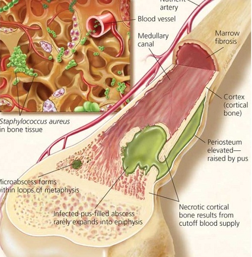 Viêm khớp nhiễm khuẩn có thể gây ra viêm tủy xương