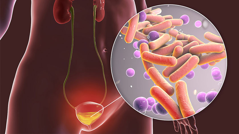 Viêm bàng quang: Nguyên nhân, triệu chứng, cách điều trị và phòng ngừa