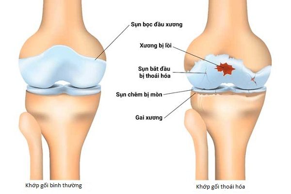 Thoái hóa khớp gối: Nguyên nhân, triệu chứng và cách điều trị