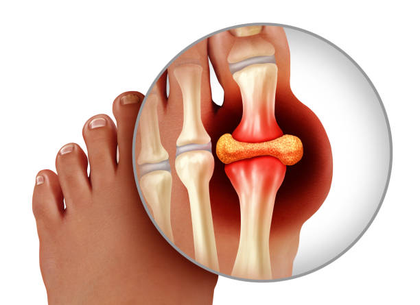 Các loại thuốc trị gout thường dùng