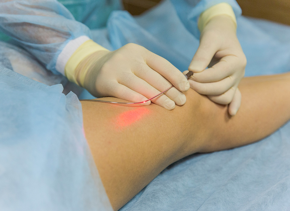 Phương pháp laser nội tĩnh mạch