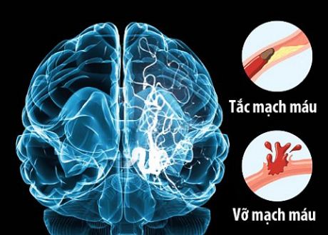 10 triệu chứng đột quỵ điển hình cần biết