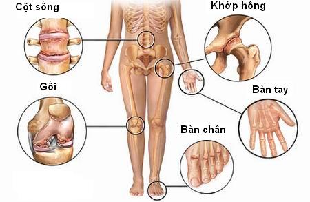 Những khó khăn trong điều trị thoái hóa khớp