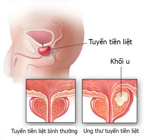 Dấu ấn của  ung thư tuyến tiền liệt