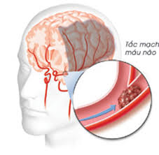 Hỏi: Mẹ tôi bị tai biến vẫn còn cục máu đông trong não?