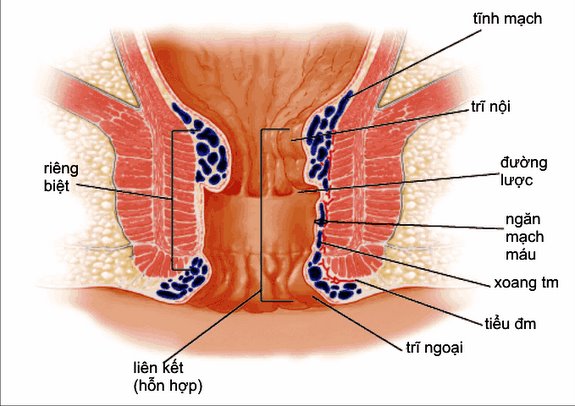 Triệu chứng nhận biết bệnh trĩ nội